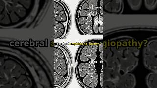 Sūta Gosvāmī amp cerebral amyloid angiopathy kneetie stroke ADHD dubaitelemedicine shorts [upl. by Volny]