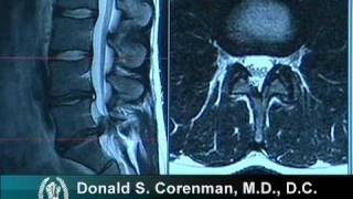 How to Read a MRI of a Lumbar Herniated Disc  Lower Back Pain  Colorado Spine Surgeon [upl. by Love]