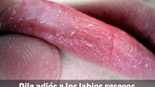 REMEDIO NATURAL PARA LOS LABIOS RESECOS  Mejor Salud [upl. by Nolita]