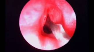 Endoscopic cricoid split [upl. by Trude]