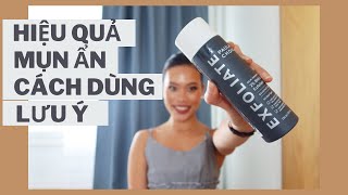 BHA Paulas Choice  Cách dùng BHA mụn ẩn giải đáp thắc mắc review [upl. by Marlette466]