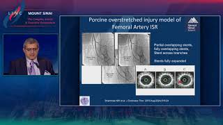 Atherectomy for Restenosis Future of Combination Therapy [upl. by Angelique543]