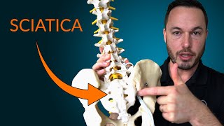 Understanding Sciatica Everything you need to know about the causes and treatment of sciatica [upl. by Ahselat]