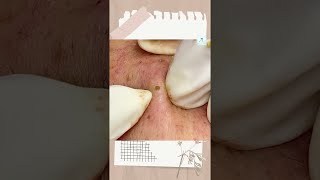 Big Cystic Acne Blackheads Extraction Blackheads amp Milia Whiteheads Removal Pimple Popping shorts [upl. by Arba528]