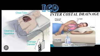 intercostal drainagerecurrent plueral effusionmbbsprocedure medicose Sudarshanlipane17 ⛑️⛑️🩺 [upl. by Oliy]