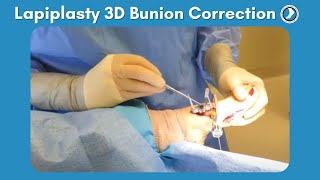 Lapiplasty Procedure  3D Bunion Correction with Dr Paul Steinke [upl. by Llenej]