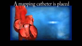 Ventricular Tachycardia VT Ablation [upl. by Sinclare239]