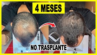 🤫 Recupero el Pelo en 4 meses  SIN trasplante capilar en ESPAÑA [upl. by Gelasias]