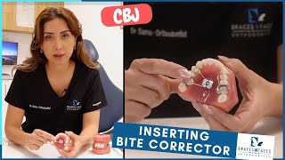 How To Insert Bite Corrector and Turning Your Expander at Home Braces N Faces [upl. by Jed]