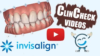 Invisalign ClinCheck Videos For Various Teeth Conditions [upl. by Maharg]