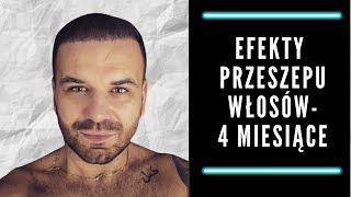 Efekty przeszczepu włosów  4 miesiące [upl. by Thadeus]