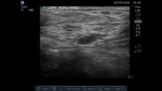 Ultrasound compression test for DVT Left Popliteal Vein Normal [upl. by Robinetta]