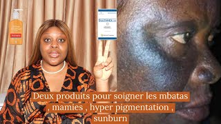 Comment guérir et éviter les brûlures du visage les mbatas  sunburn  mamies  les discolorations [upl. by Kariv165]