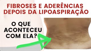 Tratamento para Fibroses e Aderências depois da lipoaspiração entenda o que aconteceu com ela [upl. by Brost]