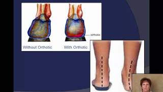 Plantar Fasciitis explained by a Podiatrist [upl. by Kevina687]