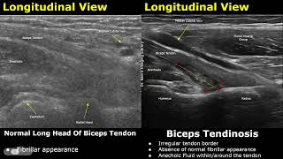 Elbow Ultrasound Normal Vs Abnormal Images  Muscles Tendons Ligaments and Nerves MSK USG [upl. by Arlyne]