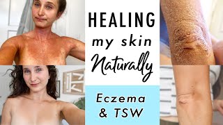 How I CURED Eczema amp Topical Steroid Withdrawal NATURALLY  My Skin Healing Journey [upl. by Assilanna822]