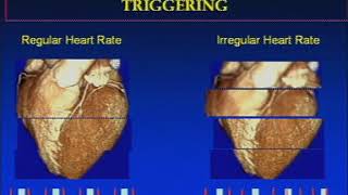 The Basics of Coronary CT Angiography [upl. by Nonac465]