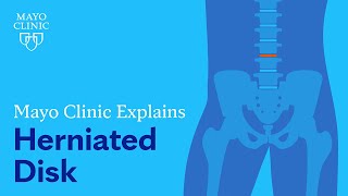 Mayo Clinic Explains Herniated Disk [upl. by Shirleen449]