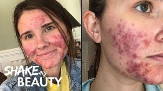 Going Out With My Severe Acne For The First Time  SHAKE MY BEAUTY [upl. by Bellew167]