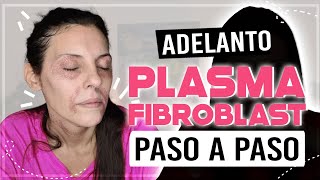 ADELANTO Plasma fibroblast paso a paso  plasmapen  que es plasmapen  CarolinaTV CarolinaSKB [upl. by Hsiekal256]