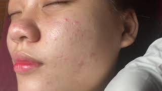 Acne Treatment Huong Da Nang  593 [upl. by Pournaras821]