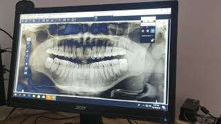 Operational Training Tutorial on OPG  OPG  Dental OPG  Carestream  Santosh Kuikel [upl. by Riegel927]