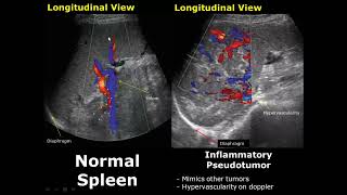 Spleen Ultrasound Normal Vs Abnormal Image Appearances Comparison  Splenic Pathologies On USG [upl. by Buchalter505]