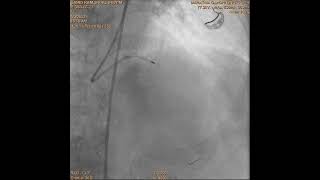 Rotational atherectomy in calcified coronary [upl. by Aiva126]