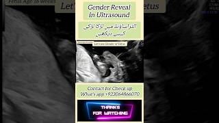 Gender in Ultrasound 16 weeks [upl. by Zaneski]