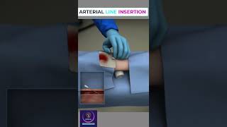 Arterial line insertion shorts [upl. by Anstice]