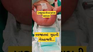 Imperforate anus treatment  newborn anomaly youtubeshorts shortsshortvideo babycareviralvideo [upl. by Muslim985]