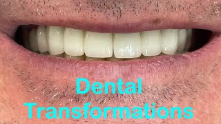 Before and After  Beautiful Dental Transformations GreatTeeth [upl. by Egdirdle]