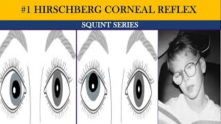 Phoria vs tropia  types of squint  Hirschberg Corneal Reflex Test HCRT  Squint series [upl. by Isman502]