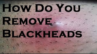 How to remove blackheads [upl. by Morril]