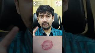 Treatment of Fungal Infection of Private Parts  Dr Rajdeep Mysore  Doctors Circle shorts [upl. by Silvan]