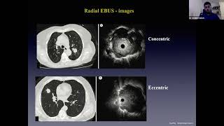 Interventional Pulmonology  Endobronchial Tuberculosis [upl. by Rufe]