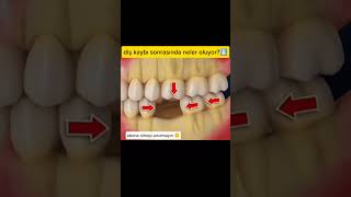 diş kaybı sonrasıdışçekimdişhekimliğidişhekimliğifakültesi dentalsağlıkgülmekshorts türkiye [upl. by Dnomyar]