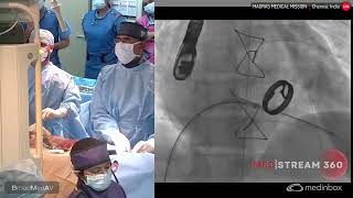 Mitral TTK Chithra Paravalvular Leak Closure [upl. by Aika]