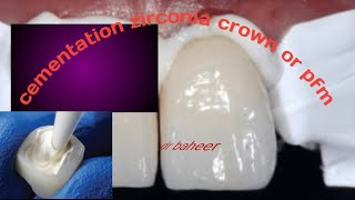 cementation to zirconia crown or pfm crown بالتفصيلdental crown [upl. by Zetniuq]