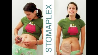 Ostomy Bag Leaking Learn how to make a better bond to stop ostomy leaks  Stomaplex Equalizer [upl. by Lyrrehs]