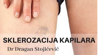 Uklanjanje proširenih kapilara skleroterapija sklerozacija vena cene cena cenovnik [upl. by Cull]