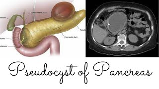 Pseudocyst of Pancreas [upl. by Yeblehs86]