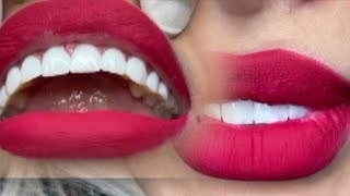 Getting Front Teeth Veneers before and after closeup  procedure [upl. by Yaker]