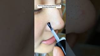 Get Rid Of Blackheads  Remove Blackheads Naturally At Home skincare beauty youtubeshorts diy [upl. by Nelly]