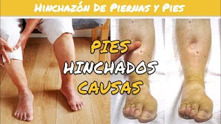 ⚕️🩺 HINCHAZÓN DE PIES Y TOBILLOS Causas y Recomendaciones [upl. by Slen]