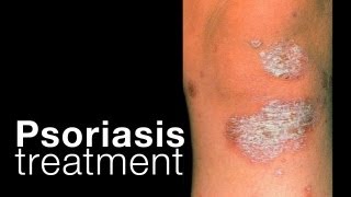 Psoriasis treatment options  related issues [upl. by Yddeg]