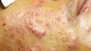 Acné kystique et boutons sur le visage cystic acne extraction [upl. by Pirali764]