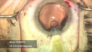 Femtosecond Assisted Marfanoid Lens Removal with Toric IOL Placement [upl. by Sillek366]