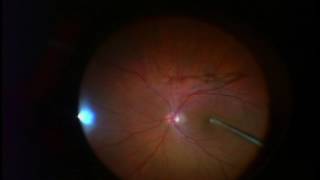 Large Gigantic Floater in Monocular Patient  FOV for Large Floater [upl. by Bowles]